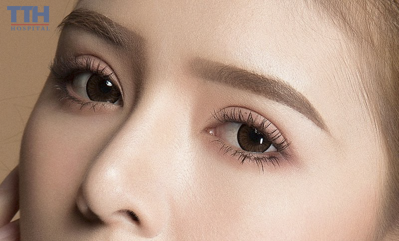 Cắt mí mắt sửa lại